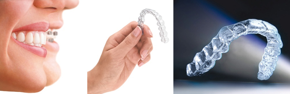 invisalign_ la alternativa a la ortodoncia clásica