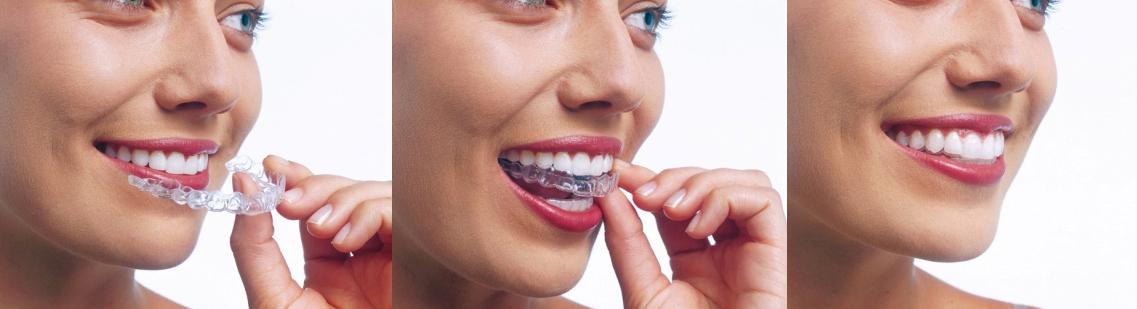 invisalign_ la alternativa a la ortodòncia clàssica