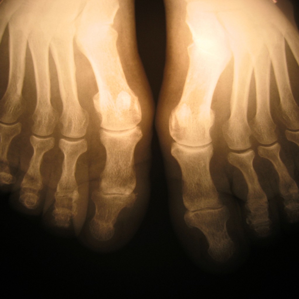 causas y consecuencias déficit vitamina D