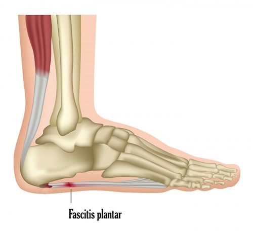 fascitis plantar_lesiones corredores_running