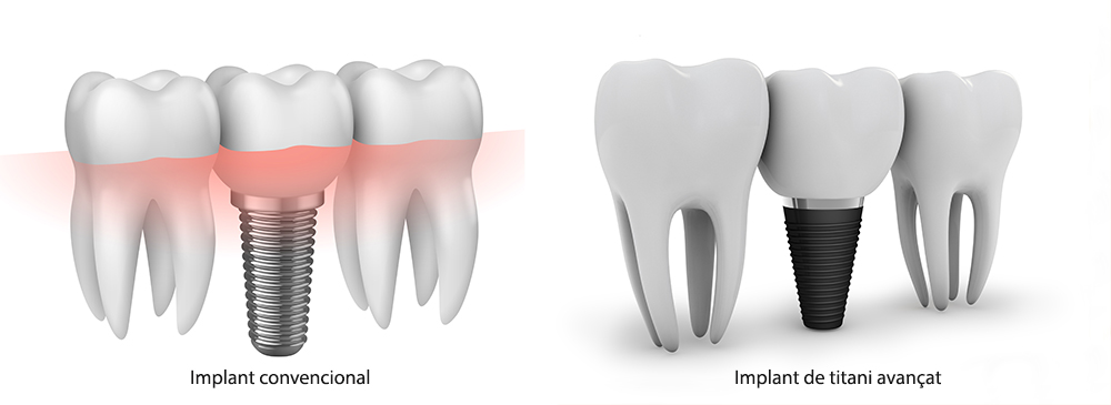 implants dentals de titani avançat