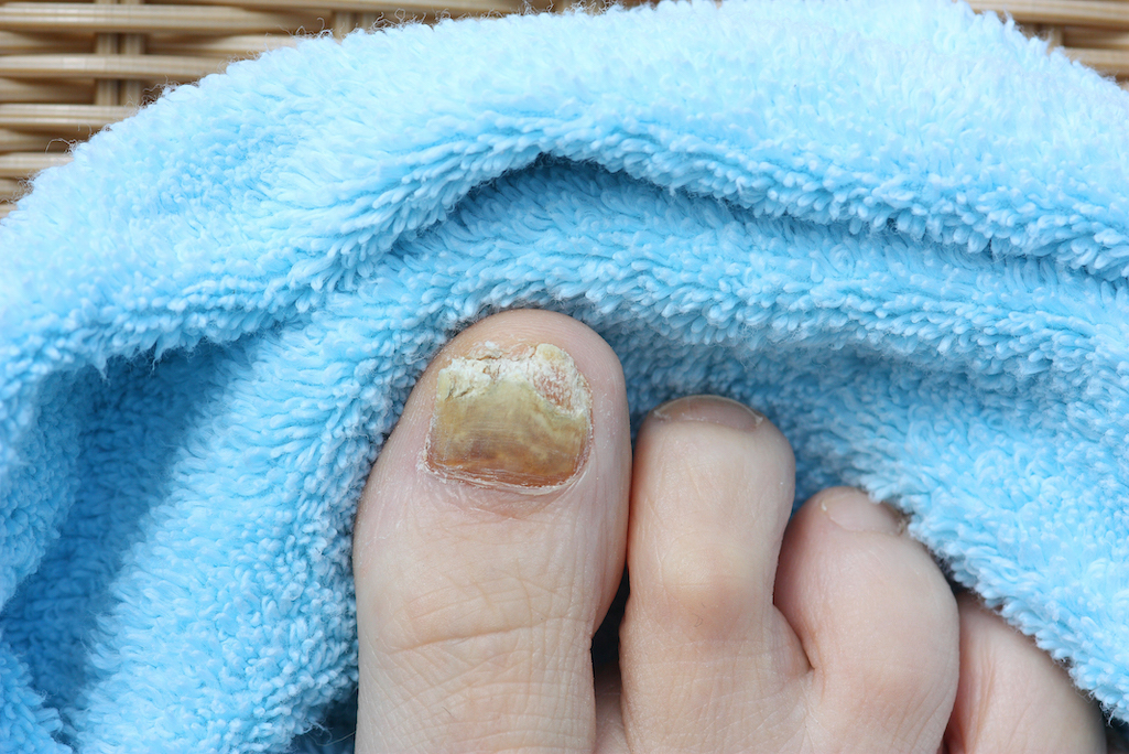 Onicomicosis hongos en las uñas de los pies  Dra LOREA BAGAZGOITIA