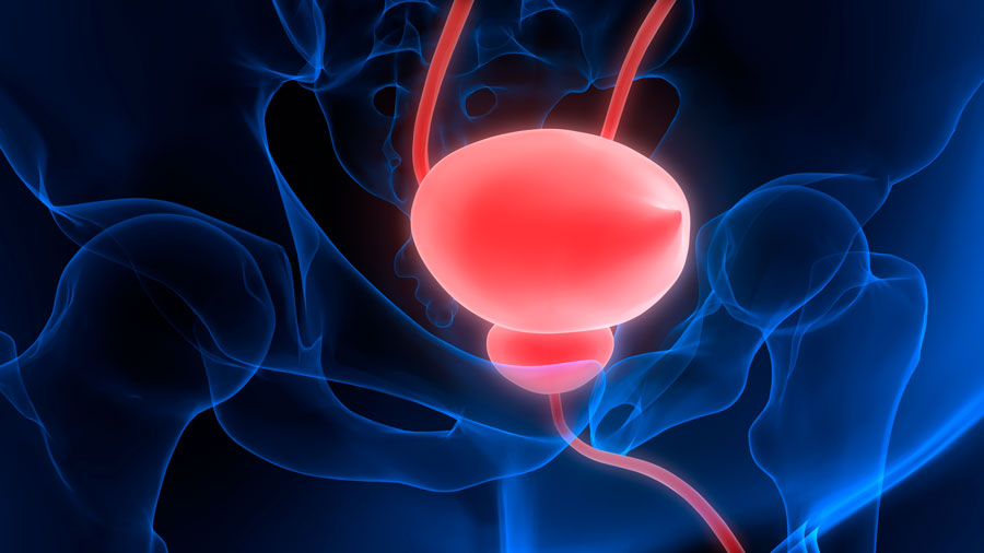 probleme de prostata tratamentul rapid al prostatitei cronice