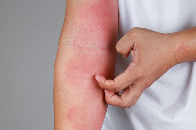 Lee más sobre el artículo Cómo tratar la escarlatina en adultos: síntomas, tratamiento y contagio